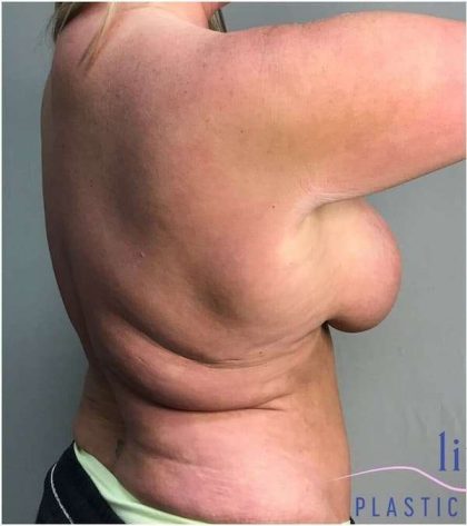 Back Lift Before & After Patient #292