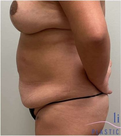 Tummy Tuck Before & After Patient #303