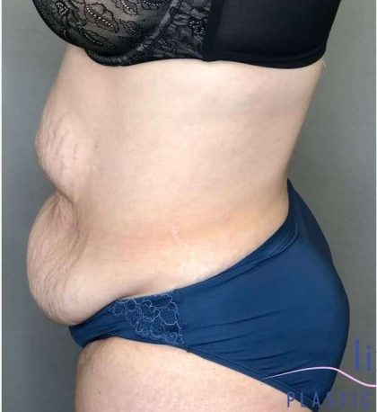 Tummy Tuck Before & After Patient #314