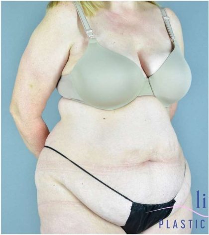 Tummy Tuck Before & After Patient #325