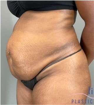 Tummy Tuck Before & After Patient #332
