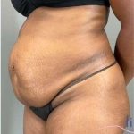 Tummy Tuck Before & After Patient #339