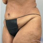 Tummy Tuck Before & After Patient #346