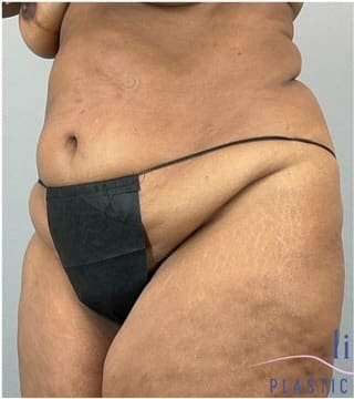 Tummy Tuck Before & After Patient #346