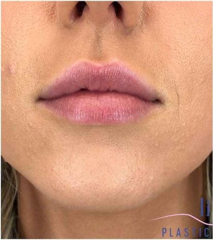 Injectables&Fillers Before & After Patient #135