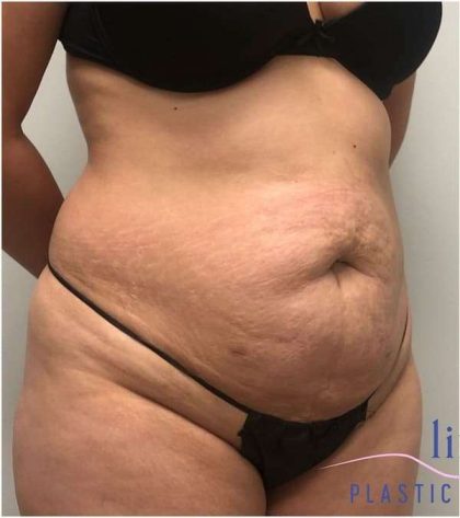 Tummy Tuck Before & After Patient #357