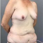 Tummy Tuck Before & After Patient #368