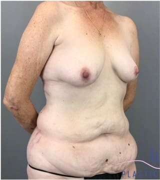 Tummy Tuck Before & After Patient #368
