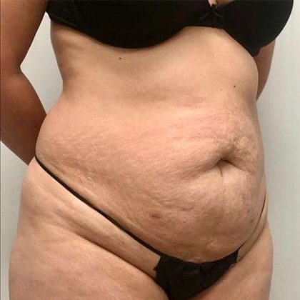 Tummy Tuck Before & After Patient #379