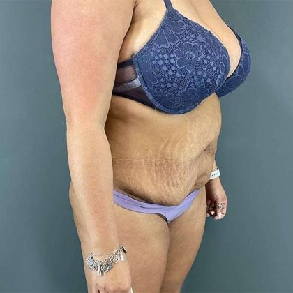 Tummy Tuck Before & After Patient #390