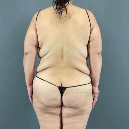 Tummy Tuck Before & After Patient #401