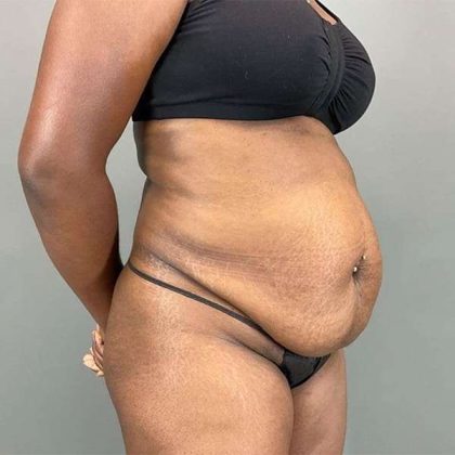 Tummy Tuck Before & After Patient #423