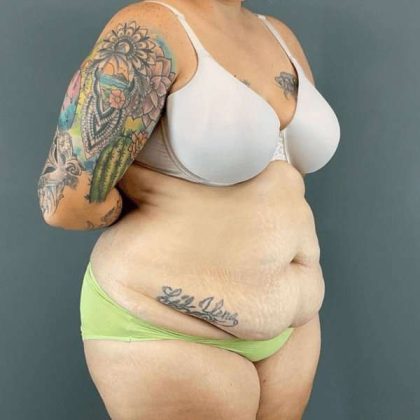 Tummy Tuck Before & After Patient #434