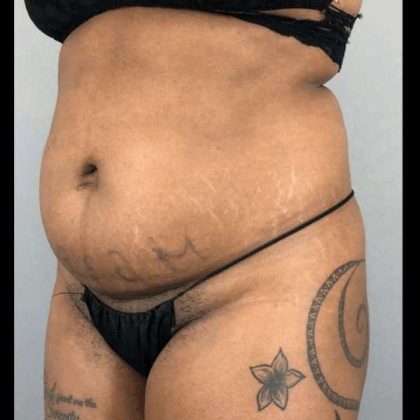 Tummy Tuck Before & After Patient #454