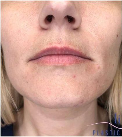 Injectables&Fillers Before & After Patient #140
