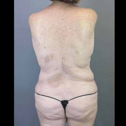 Tummy Tuck Before & After Patient #465