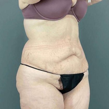 Tummy Tuck Before & After Patient #476