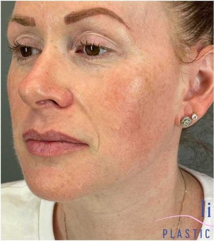 Injectables&Fillers Before & After Patient #118