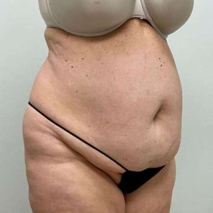 Tummy Tuck Before & After Patient #498