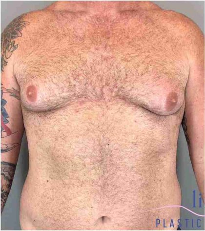 Gynecomastia Before & After Patient #560