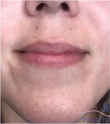 Injectables&Fillers Before & After Patient #145