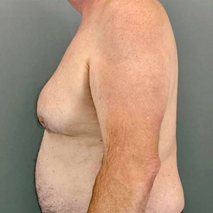Gynecomastia Before & After Patient #571