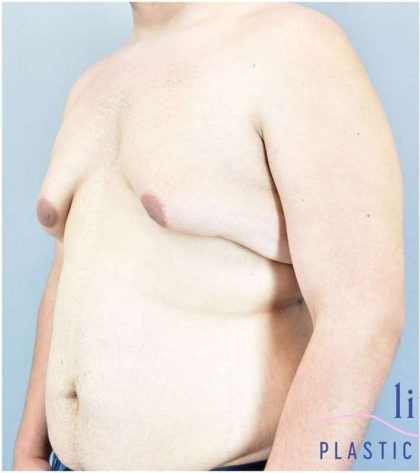Gynecomastia Before & After Patient #582