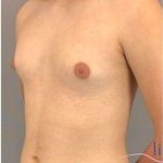 Gynecomastia Before & After Patient #593