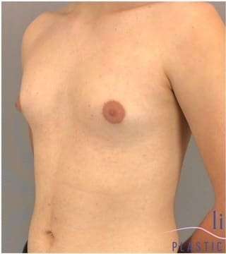 Gynecomastia Before & After Patient #593