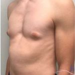 Gynecomastia Before & After Patient #604