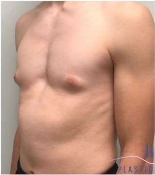 Gynecomastia Before & After Patient #604