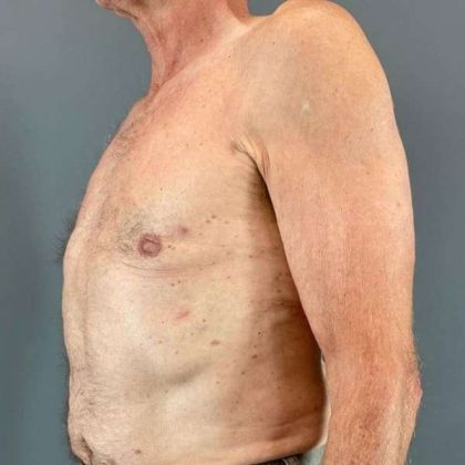 Gynecomastia Before & After Patient #611