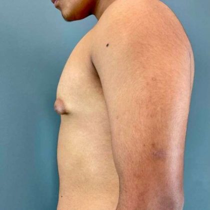 Gynecomastia Before & After Patient #622