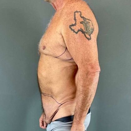 Gynecomastia Before & After Patient #629
