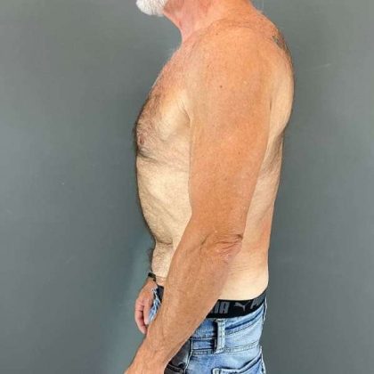 Gynecomastia Before & After Patient #642