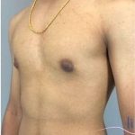 Gynecomastia Before & After Patient #653