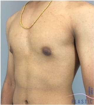 Gynecomastia Before & After Patient #653
