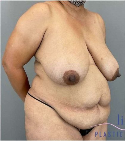 Breast Reduction Before & After Patient #664