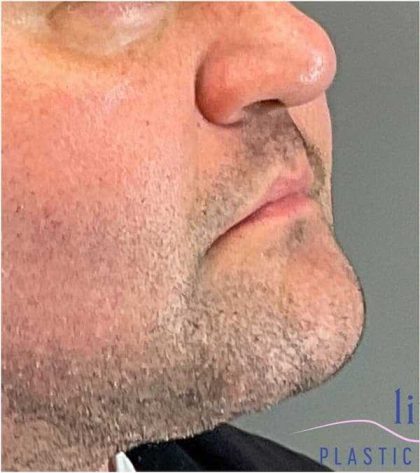 Injectables&Fillers Before & After Patient #150
