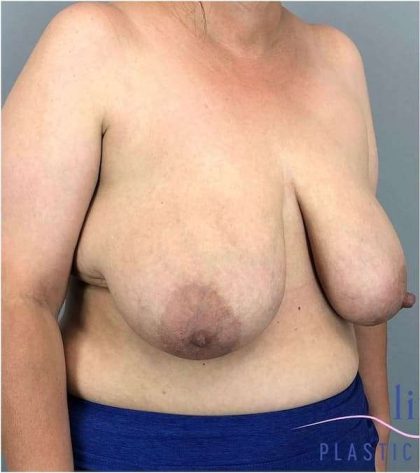 Breast Reduction Before & After Patient #675