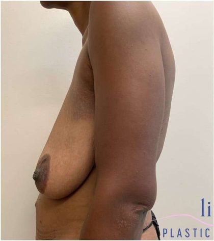 Breast Reduction Before & After Patient #686