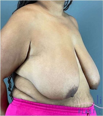 Breast Reduction Before & After Patient #708