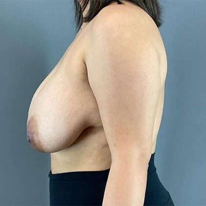 Breast Reduction Before & After Patient #719