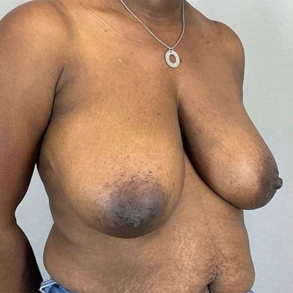 Breast Reduction Before & After Patient #730