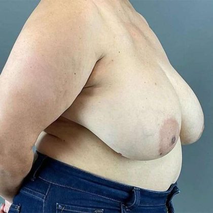 Breast Reduction Before & After Patient #763