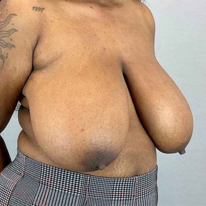 Breast Reduction Before & After Patient #774
