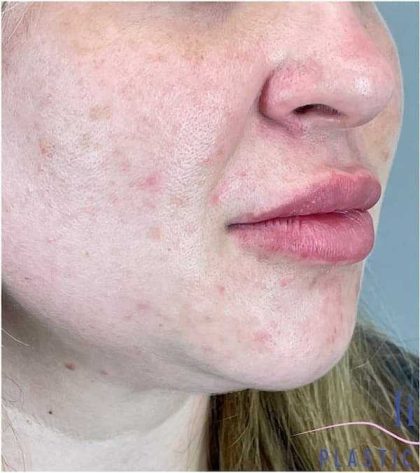 Injectables&Fillers Before & After Patient #155
