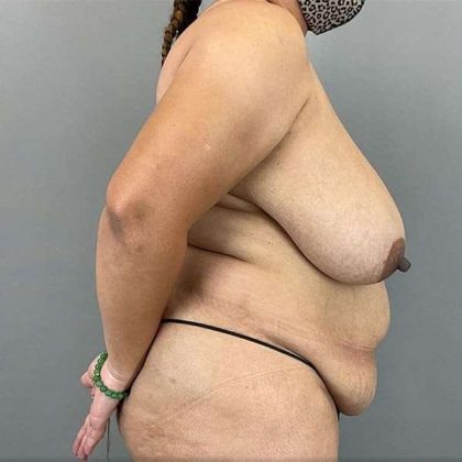 Breast Reduction Before & After Patient #785