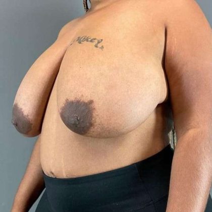 Breast Reduction Before & After Patient #792
