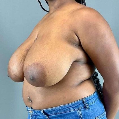 Breast Reduction Before & After Patient #810